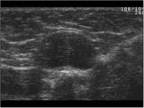 Head and Neck | 4.5 Miscellaneous : Case 4.5.1 Cysts | Ultrasound Cases