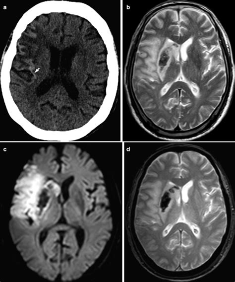 Hemorrhagic Stroke Mri