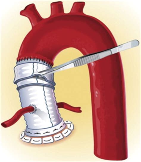 Aortoplasty for Management of the Dilated Distal Ascending Aorta During Proximal Aortic ...