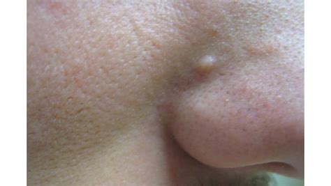 Fibrous Papules or A Clear Bump on the Tip of the Nose