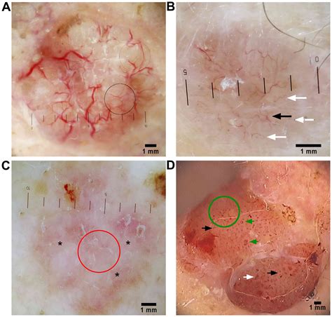 Vascular patterns in basal cell carcinoma: Dermoscopic, confocal and ...