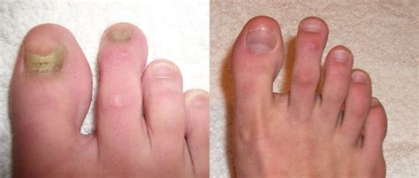 Laser Nail Treatment | Futch Podiatry