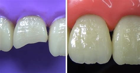 Composite Restoration Of Fractured Anterior Tooth Is Satisfying To Watch