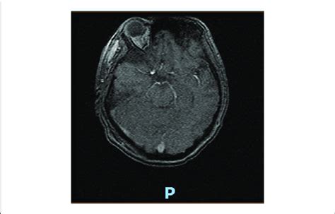 | MRI brain (cross-section at pons) consistent with acute infarct of ...