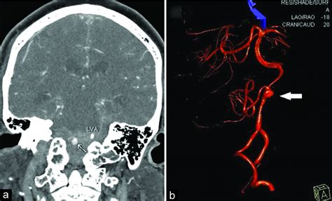 Surgical Neurology International