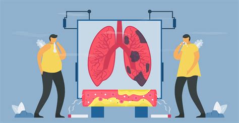 enfermedad pulmonar obstructiva crónica o EPOC 1212707 Vector en Vecteezy