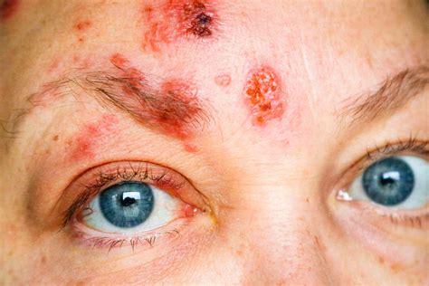 What Does Shingles Look Like? Shingles Rash Pictures