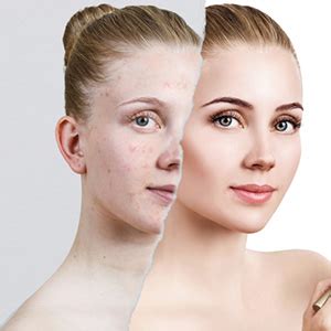 Dermatologist Near Me East Northport NY - Acne Treatment