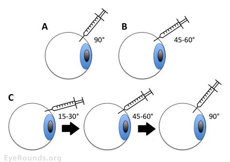 Intravitreal Injection Technique: a primer