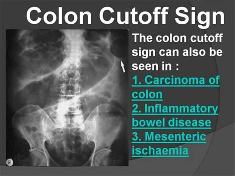 Colon cutoff sign xray abdomen | Radiology imaging, Medical mnemonics, Radiology