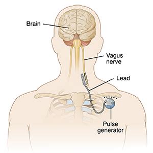 Understanding Vagus Nerve Stimulator (VNS) Placement | Saint Luke's ...