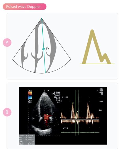 Pulsed Wave Doppler – Cardiovascular Education