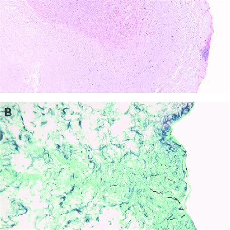 Chronic deciduitis, isolated to the decidua basalis. The decidua shows... | Download Scientific ...