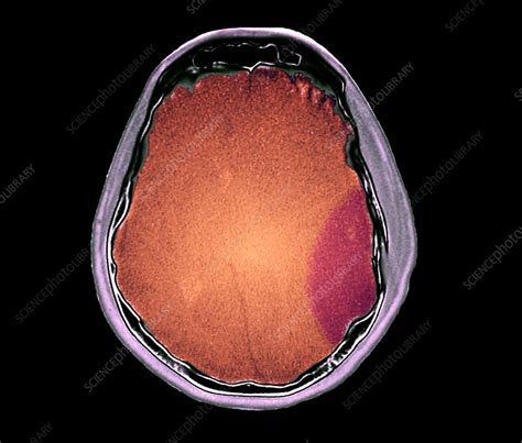 Skull fracture, CT scan - Stock Image - C055/2655 - Science Photo Library