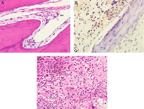 Histopathologic staining of eosinophils in the periosteum and mucosa in... | Download Scientific ...