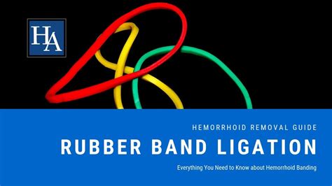 Rubber Band Hemorrhoid Treatment at William Clark blog