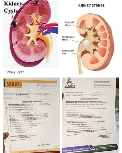 👆 KIDNEY CYST & STONE CASE RESPONDED SUCCESSFULLY BY MODERN HOMOEOPATHY TREATMENT. Latest ...