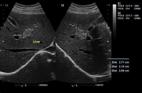 Cavernous Hemangioma Liver Ultrasound