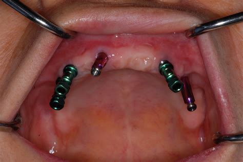 Periodontal - Implant Cases by Dr. Thomas Kang: A maxillary overdenture case