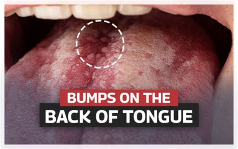 Bumps On The Back Of The Tongue | Causes, Treatment & Prevention