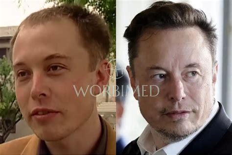 Elon Musk Hair Transplant l Before and After