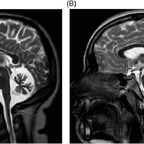 Midsagittal T2-weighted brain MRI of two siblings, a 19-year old woman... | Download Scientific ...