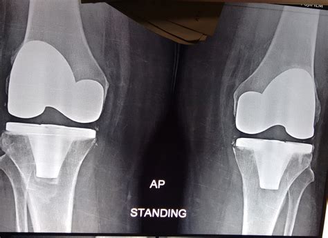 Bilateral total knee replacement (TKR) in an obese lady - Bone & Joint ...