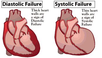 Systolic heart failure | ภาพจาก http://www.afmc.org/Graphics/consumer/healthinfo ... | Cardiac ...