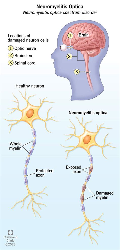 Neuromyelitis Optica (NMO): What It Is, Symptoms & Treatment