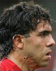 How Carlos Tevez got his Neck Scars - FootyBlog.net