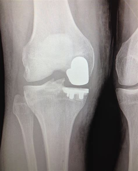 Knee Replacement: What to Consider - US News