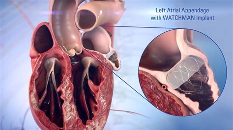 Left Atrial Appendage Closure | Heart Care | Intermountain Healthcare