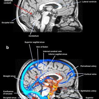 The figure shows the tentorium cerebelli, the falx cerebri and other ...