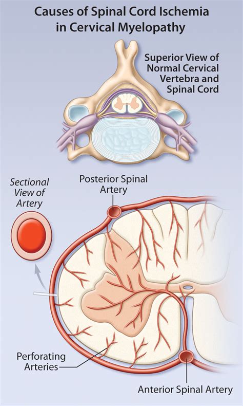 Diagnosis and Management of Cervical Myelopathy | HealthPlexus.net