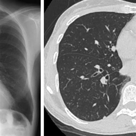 (A, B) Chest X-ray showed hyperinflation of the lungs. Chest... | Download Scientific Diagram