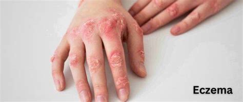 Skin Allergy: Reason & Treatment