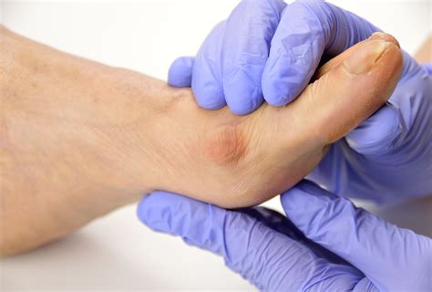 Bunion Surgery: Complications & Recovery Time - eMediHealth