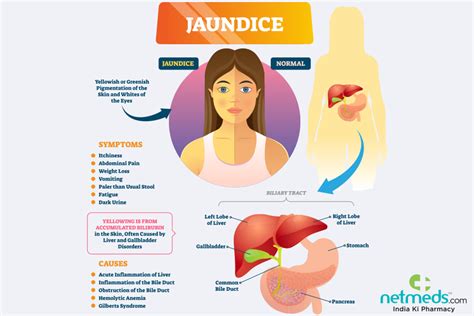 Jaundice in Adults: Causes, Symptoms and Treatment