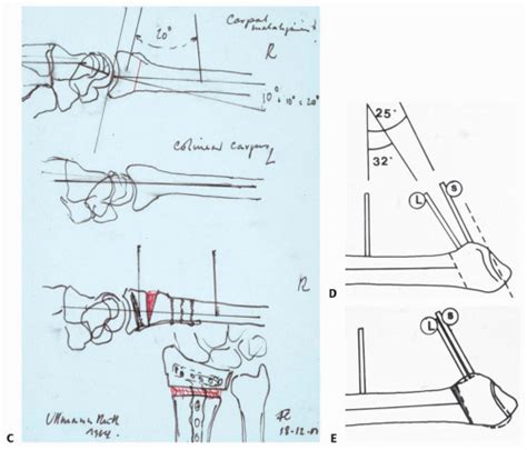 Corrective Osteotomy for Distal Radius Malunion | Musculoskeletal Key