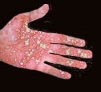 Skin condition with red patches.| Interactive Health