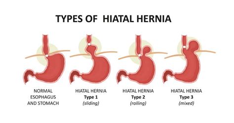 Hiatus Hernia - Dr. Shwetal Dighe