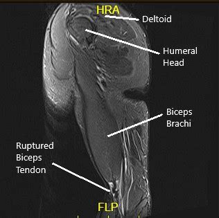 Case Study: Distal Bicep Rupture Management in 38 yr. Old Female