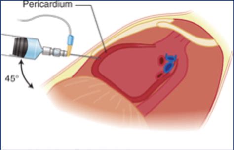 Pericardial Diseases | Dr Krasopoulos