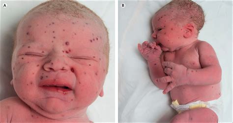 Langerhans cell histiocytosis presenting as a blueberry muffin rash ...