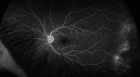 Fluorescein Angiography Retina Test | Mid Atlantic Retina