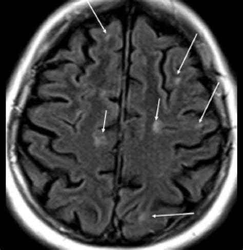 The Multiple Sclerosis Lesion Checklist - Practical Neurology