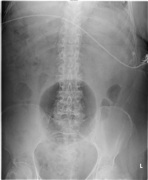 Diverticulitis X Ray