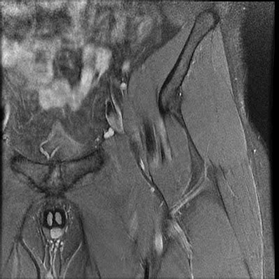 Radiology Cases: Snapping Hip Syndrome