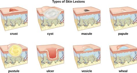 Skin Lesions Types