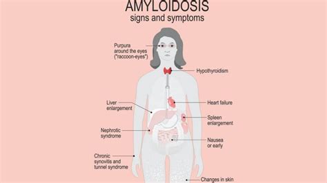 Amyloidosis: Causes, Symptoms, and Treatments | 1MD Nutrition™